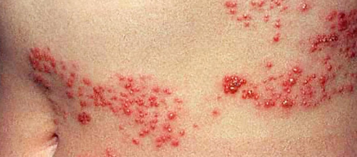 Έρπης ζωστήρας: Τι πρέπει να κάνετε στην περίπτωση που εκδηλώσετε τα συμπτώματα;